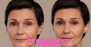 Deal With Loose Skin After Weight Loss